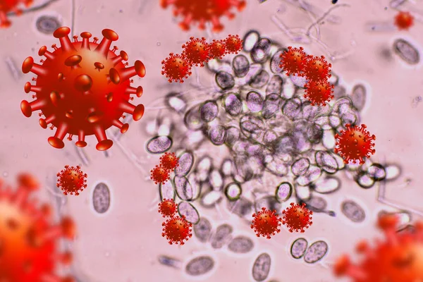 Corona Virüs Hastalığı Covid Enfeksiyonu Tıbbi Illüstrasyon Covid Adlı Corona — Stok fotoğraf