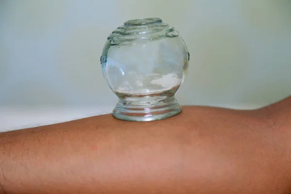 vacuum cupping treatment to patients back