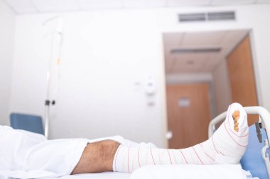 Hasta kırık bacakla hastane yatağında yatıyor. Hastanelik ve tıbbi bakım kavramı.