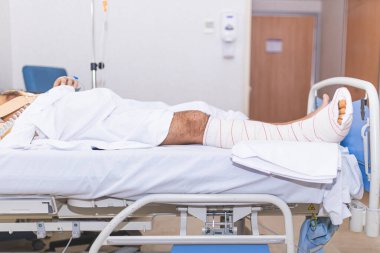 Hasta kırık bacakla hastane yatağında yatıyor. Hastanelik ve tıbbi bakım kavramı.