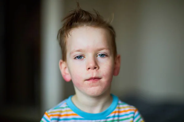 Аллергическая сыпь на лице мальчика — стоковое фото