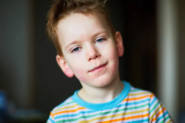 Аллергическая Сыпь Лице Мальчика — стоковое фото