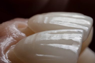  Siyah arka plan makro fotoğrafını düzeltmeden önce porselen bir Veneer