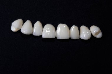 beautiful porcelain veneers on a black background ceramic porcelain white veneers, new teeth, beautiful smile close-up clipart