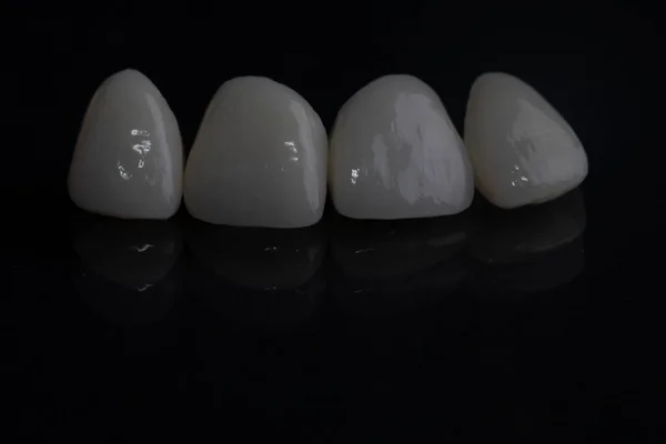 Porcelana Cerâmica Folheados Brancos Novos Dentes Belo Sorriso Close — Fotografia de Stock