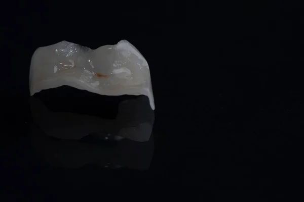 ceramic white tab in the tooth, new teeth, a beautiful smile. Close-up. Dentistry