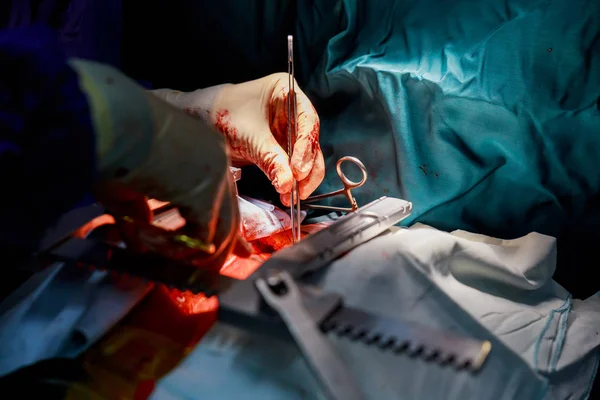 Felszálló aorta aneurizma, a műtét alatt — Stock Fotó