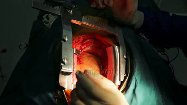 Teamwork surgeons during open-heart surgery — Stock Video