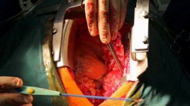 İnsan kalbi yakın çekim açılan göğsünden ameliyat sırasında dayak