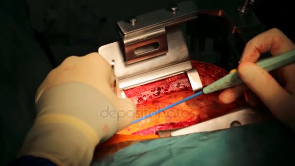 Wegwerp elektrochirurgische potlood. insnijding op de borst. — Stockvideo