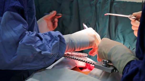 Human heart during cardiac surgery transplantation. Surgeon view — Stock Video