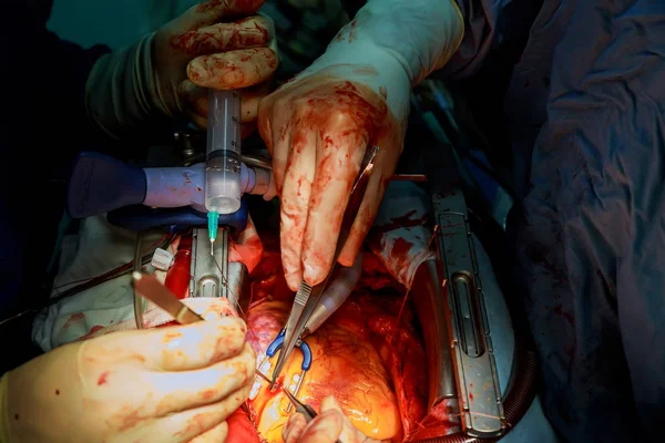 Chirurg během operace na otevřené srdce — Stock fotografie