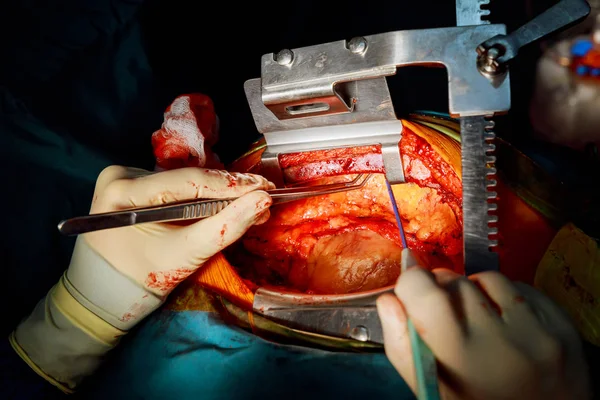 Trabajando Con Vena Cirugía Bypass Arteria Coronaria Cirugía Cardiaca — Foto de Stock