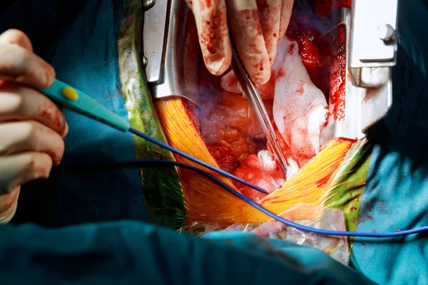 minimally invasive surgical approach with a small incision for heart valve surgery