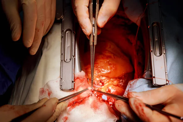 Le mani del chirurgo stanno legando un nodo durante la procedura a cuore aperto — Foto Stock