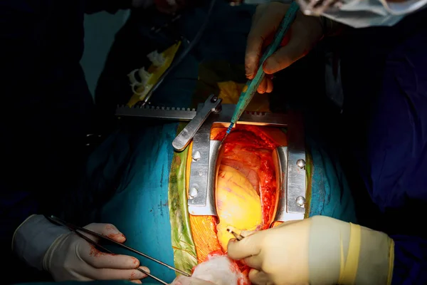 Cirurgiões de trabalho em equipe durante cirurgia de coração aberto — Fotografia de Stock