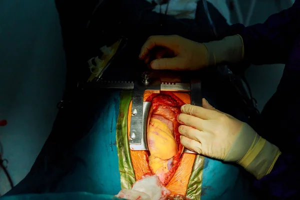 外科医は開心術中に血液の循環をペンチします。 — ストック写真