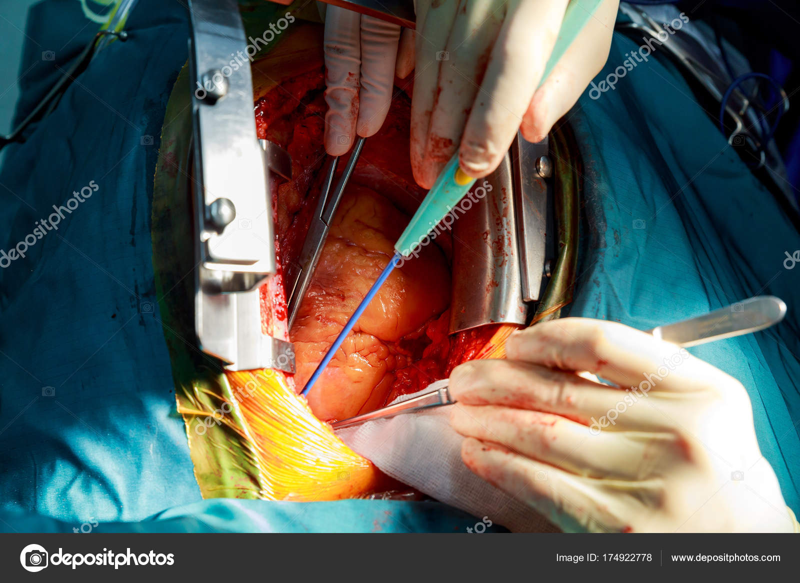 Disposable electrosurgical pencil. Incision on the chest. Cutting the chest during an operation on the heart ⬇ Stock Photo, Image by © photovs #174922778 Disposable electrosurgical pencil. Incision on the chest. Cutting the chest during an operation on the heart ⬇ Stock Photo, Image by © photovs #174922778