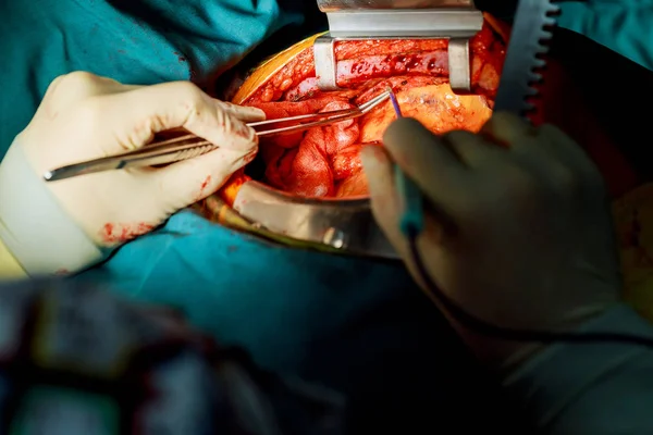 Chirurgiens du travail d'équipe pendant la chirurgie à cœur ouvert — Photo