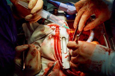 Human heart during cardiac surgery transplantation. Surgeon view chest during heart surgery clipart