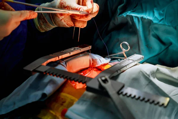 Enfoque quirúrgico invasivo con una pequeña incisión para cirugía de válvula cardíaca para extirpar transcatéter aórtico expandible —  Fotos de Stock