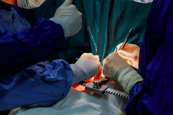 Surgeon hands are tying knot during the open heart procedure chest during heart surgery — Stock Photo, Image