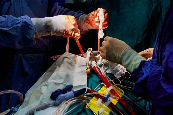 Chirurgen führen die Operation durch. Nahaufnahme der Hand des Arztes in Handschuhen während der Operation. Gesundheitswesen und medizinisches Konzept. — Stockfoto