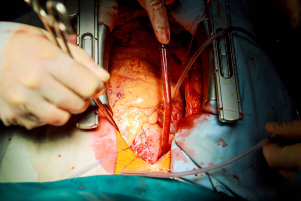 Human heart during cardiac surgery transplantation. Surgeon view chest during heart surgery