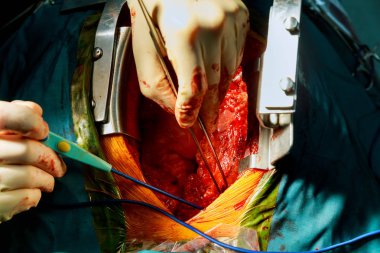 Açık kalp ameliyatı sırasında ekip çalışması cerrahlar