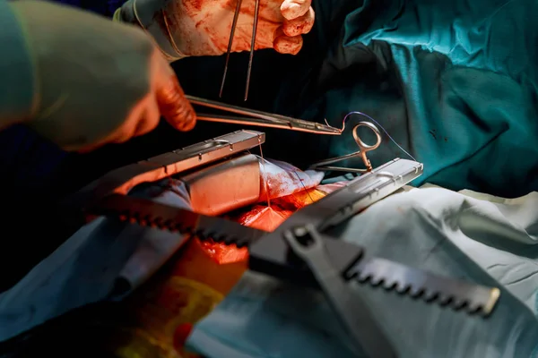 Instrumentos cirúrgicos para cirurgia cardíaca aberta — Fotografia de Stock