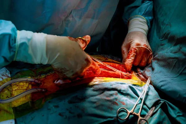 Mirando fijamente para cerrar el abdomen con una sutura en la operación a corazón abierto — Foto de Stock