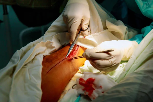 Paciente com um corte nossa incisão uma perna humana mais profunda com cicatriz sangrenta da cirurgia . — Fotografia de Stock