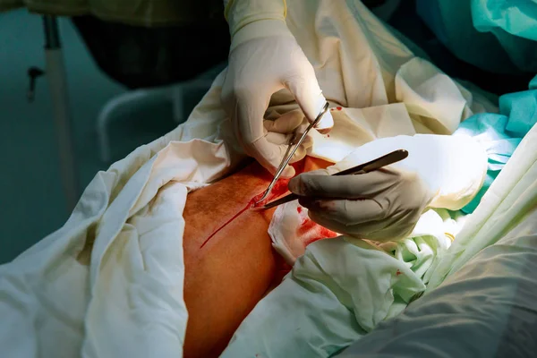 Cirujano realiza una operación en la pierna del paciente, corta la piel con un bisturí manos de un médico con instrumentos médicos en el quirófano . — Foto de Stock