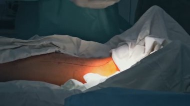 Bacak ameliyatında kanamayı durdurmak için neşter kullanarak derin bir kesik.