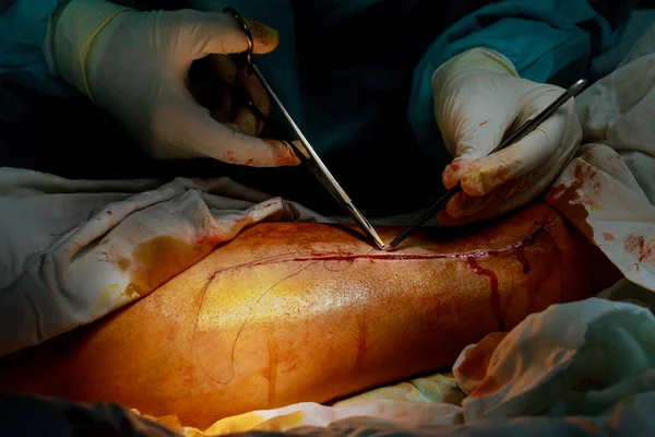 Equipo de cirujanos trabajando continuando cerrando nuestra cirugía de piernas —  Fotos de Stock