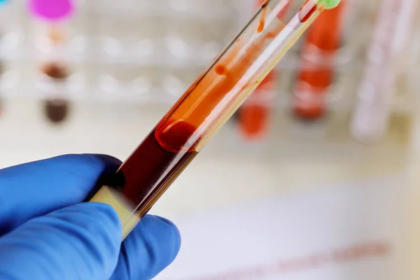 Mano de un médico sosteniendo una botella de muestra de sangre — Foto de Stock