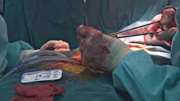 Uzavření hrudníku po operaci srdce zblízka záběr na operaci zvětšení prsou. — Stock video