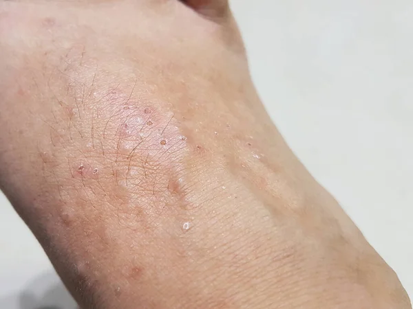 Dermatosis at foot skin from sweat allergic causes itchy and scratch in close-up view; the concept of hygiene, healthcare and medical; shoot from mobile camera.
