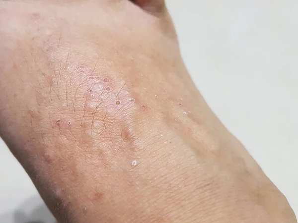 Dermatosis Foot Skin Sweat Allergic Causes Itchy Scratch Close View — ストック写真
