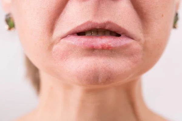 Крупный план женских губ, страдающих от герпеса — стоковое фото