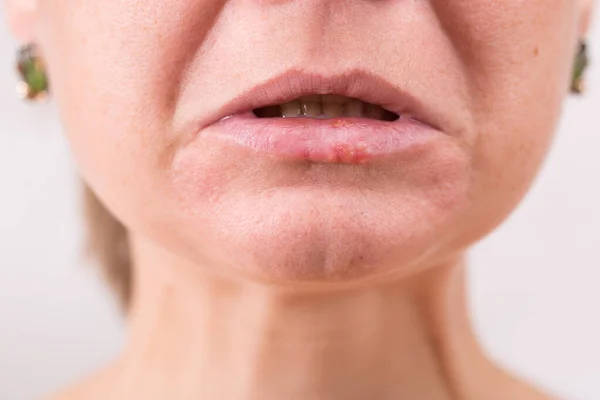 yakın çekim kadın dudağı herpes acı