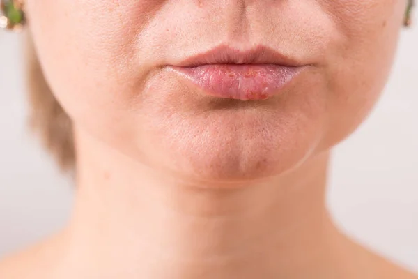 Close-up de lábios femininos que sofrem de herpes — Fotografia de Stock