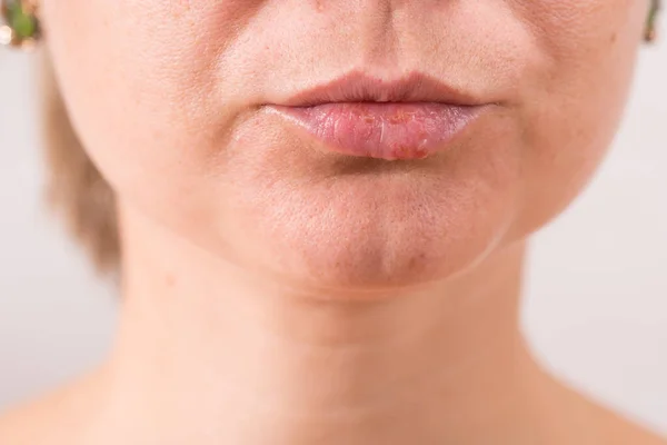 yakın çekim kadın dudağı herpes acı