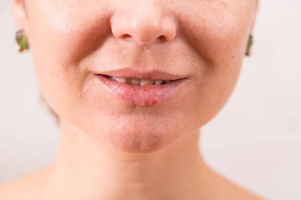 Gros plan des lèvres féminines souffrant d'herpès — Photo