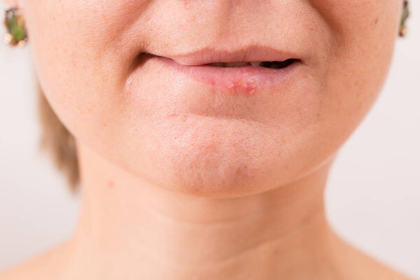 Close-up of female lips suffering from herpes