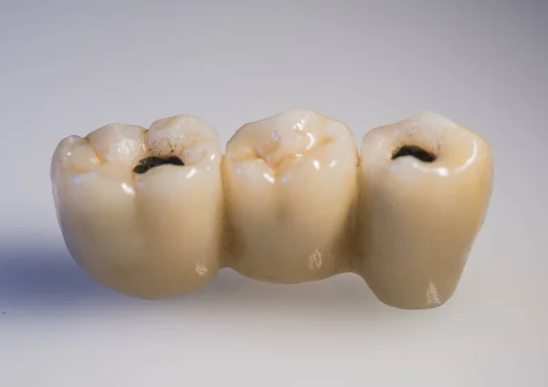 マクロ歯科インプラントの色の写真 — ストック写真