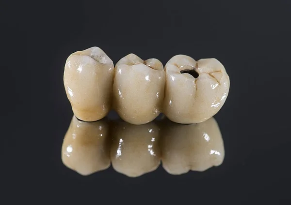 マクロ歯科インプラントの色の写真 — ストック写真
