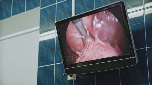Operação com equipamento laparoscópico — Vídeo de Stock