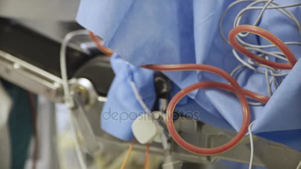Primo piano del sangue nei tubi durante l'intervento chirurgico . — Video Stock