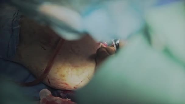 Chirurg arbeitet an der Etablierung einer Hüftprothese — Stockvideo